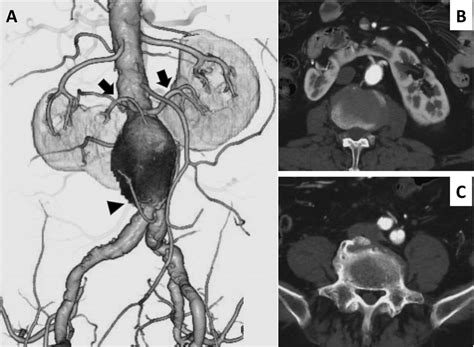 Preoperative Contrast Enhanced Computed Tomography Ct A