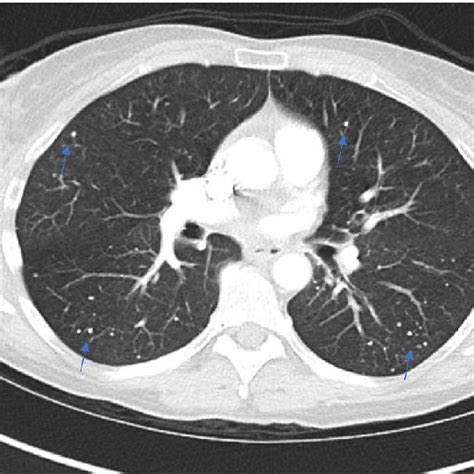 Ct Chest Showed Numerous Diffuse Subcentimeter Pulmonary Nodules