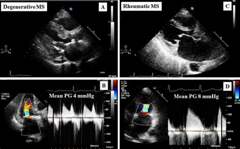 Prevalence And Clinical Characteristics Of Degenerative Mitral Stenosis