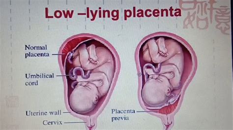Placenta Previa क्या है Low Lying Placenta Placenta Position Type Of