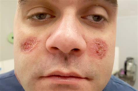 Skin Ulcer Face
