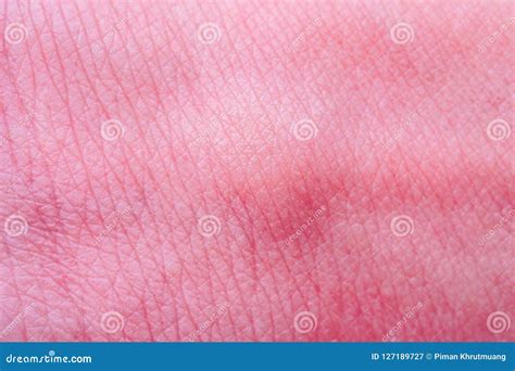 Skin Allergy With Rash After Mosquito Bite Stock Image Image Of Bite