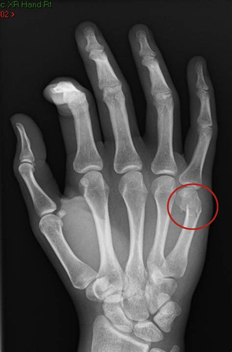 Metacarpal Fractures Fife Virtual Hand Clinic