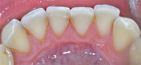 Fractured Lower Incisor Lee Ann Brady Dmds Dental Blog