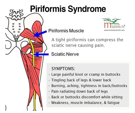 Learn The Symptoms Of Piriformis Syndrome Get Relief With Focused Stretching The Piri