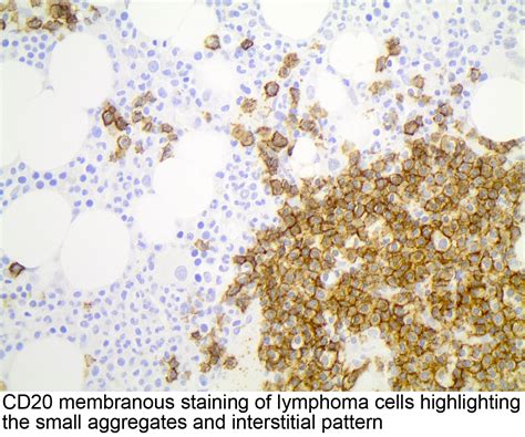 Pathology Outlines Leukemic Nonnodal Mantle Cell Lymphoma
