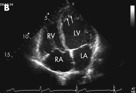 Isolated Ventricular Non Compaction In A Patient Initially Diagnosed