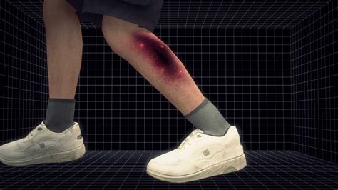 It is a severe disease of sudden onset that spreads rapidly. Symptoms and effects of Necrotizing fasciitis - YouTube