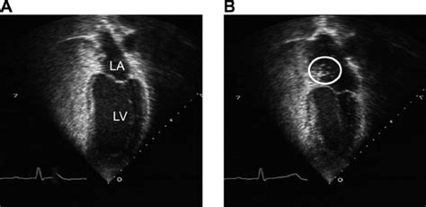 Echocardiograms From A Subject With Patent Formen Ovale Pfo ϩ A