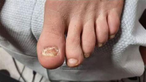 Who Has A Higher Chance Of Getting Feet Fungus Infection
