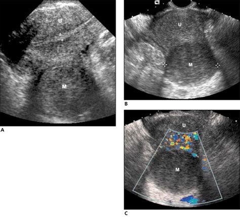 Uterine Fibroids Ultrasound
