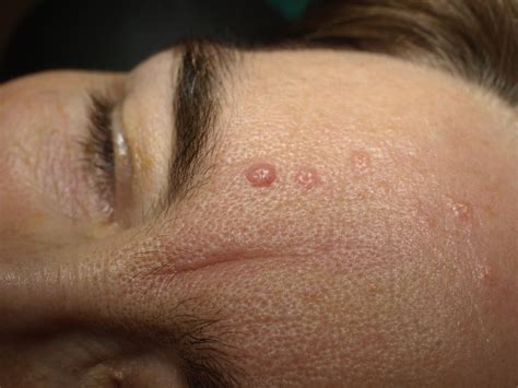 Hydrogen Peroxide Safe For Facial Seborrheic Keratoses