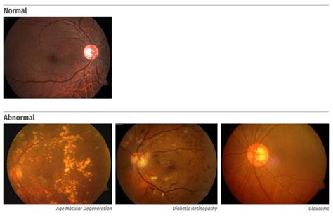 Normal Fundus Image Top Abnormal Fundus Images Bottom Download