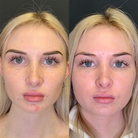 The Magic Of Prp Before And After Beauty Boost Med Spa