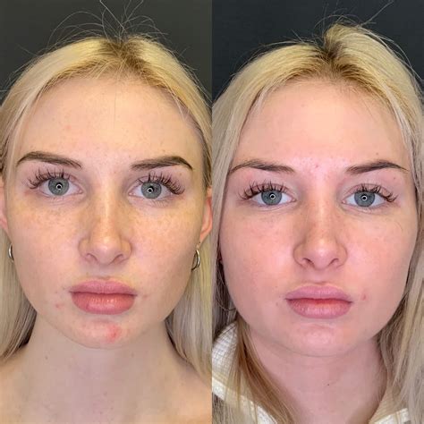 The Magic Of PRP Before And After Beauty Boost Med Spa