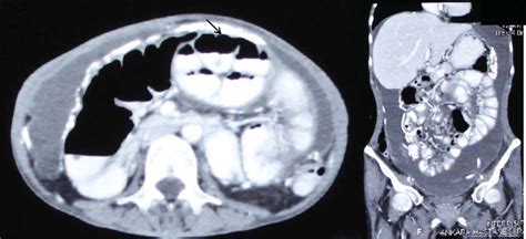 Ct Scan Of Lower Abdomen Shows Clustered Gascontaining Small Bowel