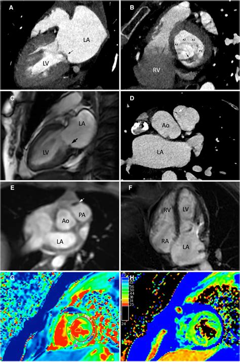 Evaluation Of The Mitral And Pulmonary Valve Vegetations Using Cardiac Download Scientific