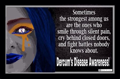 Dercum Dercums Disease