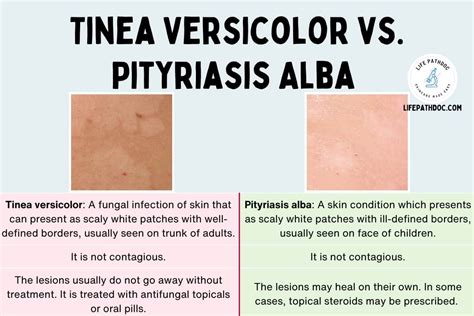 Pityriasis Alba Vs Tinea Versicolor Pictures And Differences The Best Porn Website