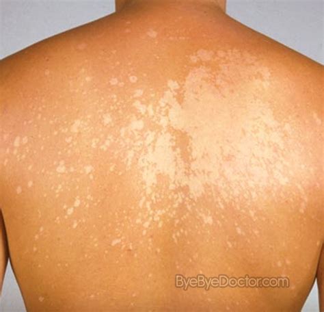 White Spots On Skin 8211 Causes Symptoms Causes Treatment And