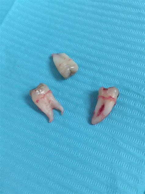 One Of The Wisdom Teeth I Had Removed Today Has Interestingly Curved