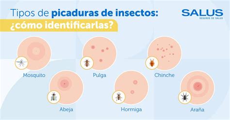 Cómo identificar distintos tipos de picaduras de insectos