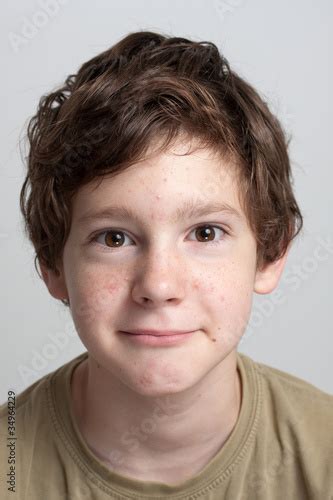 Portrait Of A Cute Teenage Boy With Face Covered With Pimples Kaufen