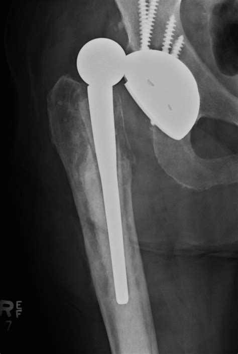 Dislocated Hip Prosthesis Radiology At St Vincents University Hospital