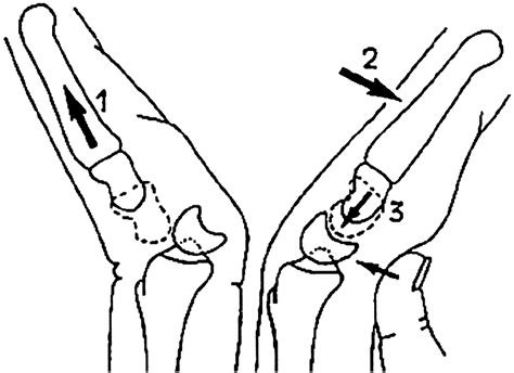 Treatment Of Acute Lunate And Perilunate Dislocations Journal Of Hand Surgery