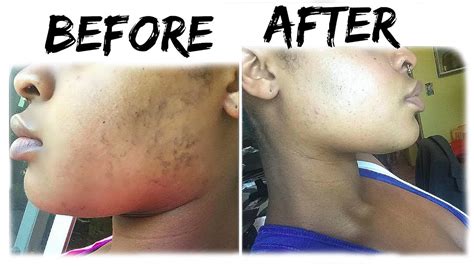 Get Rid Of Hyperpigmentation Dark Spots And Acne Scars Youtube