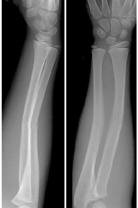 Radiographs Of A Minimally Displaced Diaphyseal Both Bone Forearm