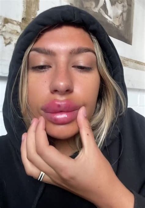 Fake Lips Plungers Beauty Trends Procedure Regrets Millie Salmon Om Hair Beauty