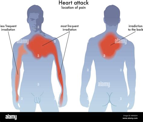 Medical Illustration Of The Heart Attack Pain Location Stock Vector