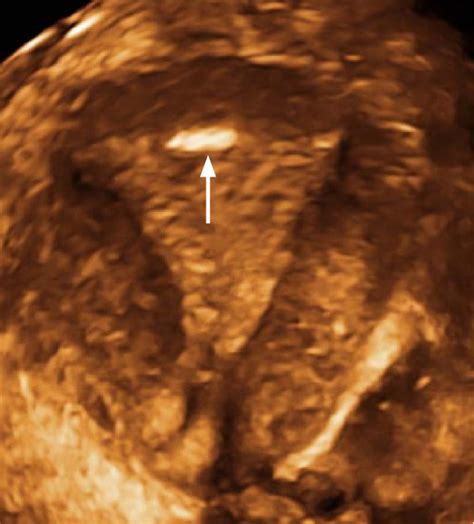 Coronal Or C Plane Of The Normal Uterus Rendered Image The
