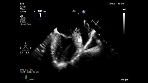 Native Mitral Valve Endocarditis Complicated With Abscess And Fistulas