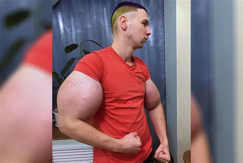 This Russian Bodybuilder With 24 Inch Biceps Could Lose His Arms