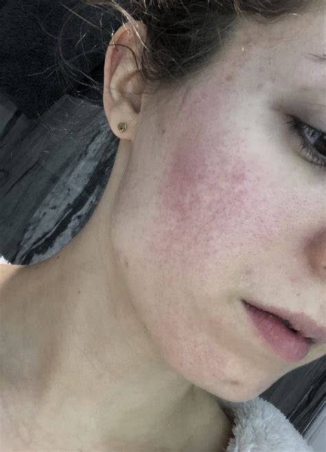 What Is This Rednessrash On My Cheeks Pictures Askdocs