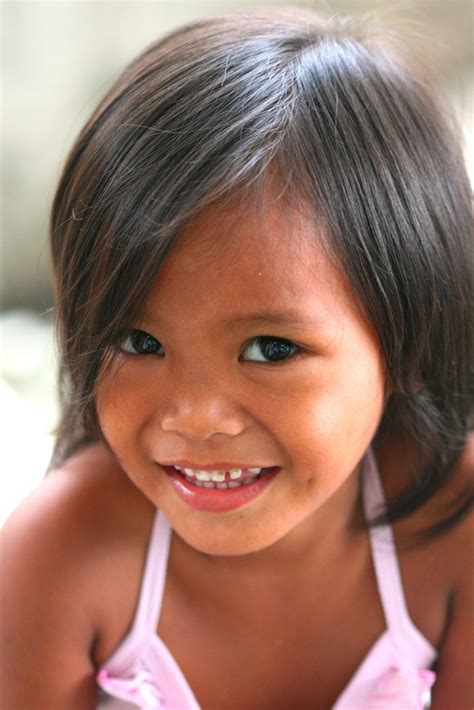 Holoprosencephaly Filipino Street Children