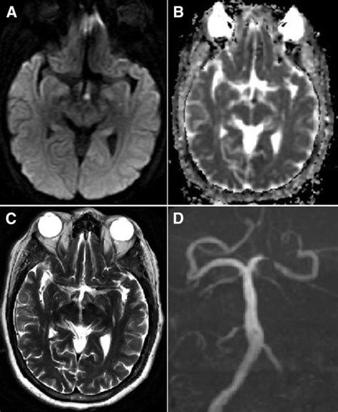 Acute Amnesia Due To Isolated Mammillary Body Infarct Journal Of