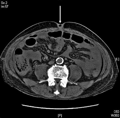 Contrast Computed Tomography Of Abdomen Showing A Rim Enhancing