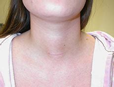 Scar After Thyroid Surgery Minimally Invasive Thyroid Surgery