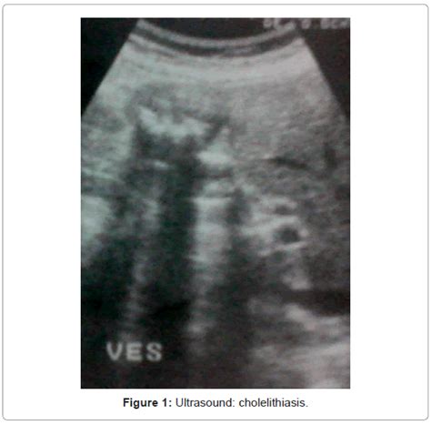 Virology Mycology Ultrasound Cholelithiasis