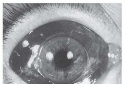 Ocular Trauma And Its Prevention Ento Key