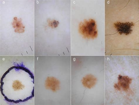 Melanoma Pictures By Stages Symptoms And Pictures