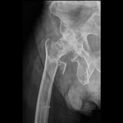 Femoral Neck And Intertrochanteric Fractures Radiographic Indicators