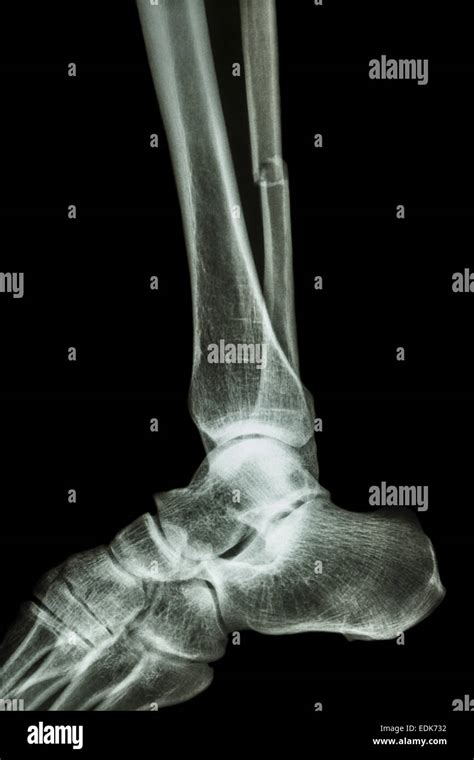 Xray Image Of Ankle Lateral View Showing Heel Fracture Stock Photo
