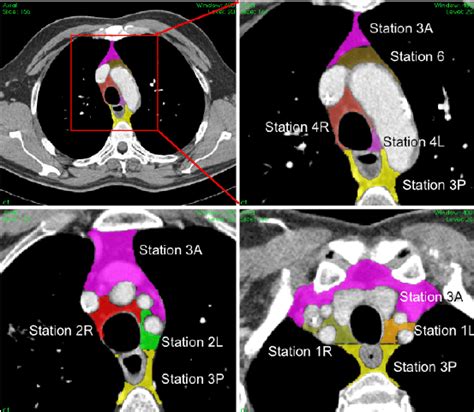 Examples Of Mediastinal Stations Delineated On A Thoracic Ct