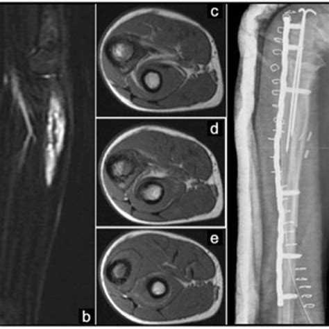 Right Proximal Ulna Ewings Sarcoma Treated With Intercalary Resection