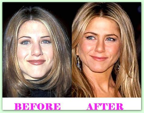Jennifer Aniston Plastic Surgery Before And After Jenniferanistonplasticsurgery