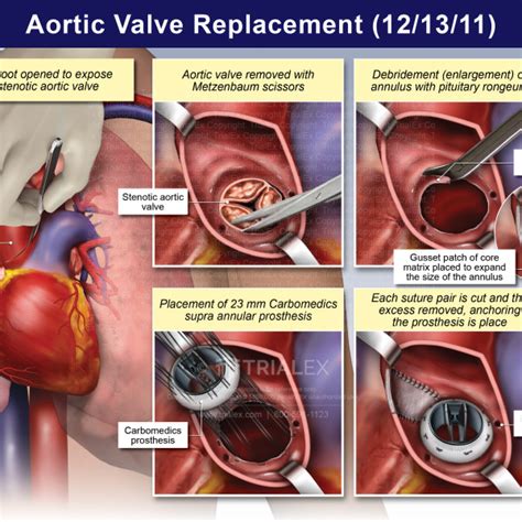 Aortic Valve Replacement Trialexhibits Inc